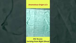 Anomalous Origin Left Circumflex Artery Arising From Right Sinus anomalous coronary artery origins [upl. by Eeimaj672]