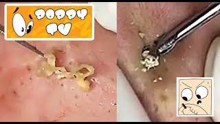 Large Closed Comedones  Whiteheads Extraction [upl. by Nnylhtak]