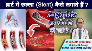 हार्ट में छल्ला Stentकैसे लगाते हैंWhen And How Angioplasty is Done How Stent is Placed in Heart [upl. by Ormond]