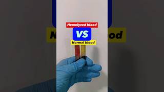 Hemolyzed blood vs Normal blood serum sample medtech medtechstudent laboratory bloodserum blood [upl. by Aneet469]