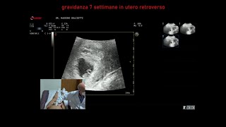 gravidanza alla settima settimana di gestazione [upl. by Nary]