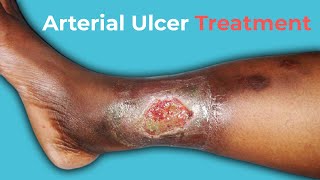 What Are Arterial Ulcers Arterial Ulcer Treatment [upl. by Johst263]