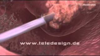 HNO 017 NasenPolypen Entfernung  PAL 169 HNO 017 Removal of nasal polyps  PAL 169 [upl. by Lema]