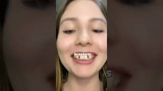 Agenesia dental dientes dentista tips parati viral fyp shorts shortvideo fypシ [upl. by Isnyl]