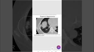 Popcorn calcificationbreast radiologyinicet neetpg [upl. by Hulbig]