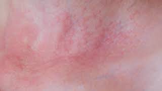 Skin Allergies  What Are Hives [upl. by Enileuqaj]