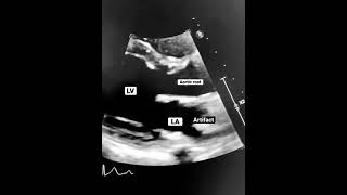 SteroidResponsive Severe Pneumonia PostCOVID19 in a Patient with PANDAS A Case Study [upl. by Faro]