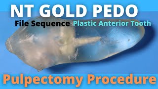 Pulpectomy Procedure  NT GOLD PEDO  File Sequence for Primary Anterior Teeth  Plastic Tooth [upl. by Persian319]