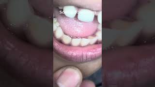 Amazing Teeth Scaling Transformation  Before amp After Results [upl. by Rider]