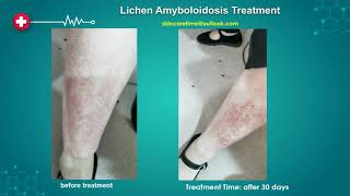 Lichen Amyloidosis Treatment Case Study 2019 2022 [upl. by Olemrac]