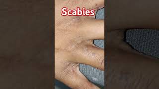 scabies skincare fungaldisease skin diseases [upl. by Val]