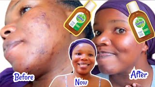 HOW TO USE DETTOL ANTISEPTIC LIQUID TO TREAT PIMPLES  ACNE DARK SPOTS SCARS amp HYPERPIGMENTATION [upl. by Esimaj]