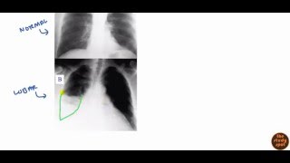 Community Acquired Pneumonia for USMLE Step 2 [upl. by Darbee]