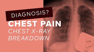 Chest XRay breakdown assessing multiple lung nodules [upl. by Annoirb]