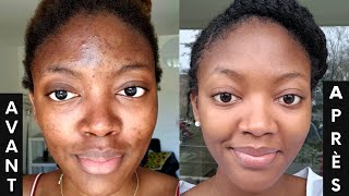 L ACNÉ COMMENT s en DÉBARRASSER 3 PRODUITS contre les boutons et les tâches🔥  SKINCARE ROUTINE💦 [upl. by Auburta555]