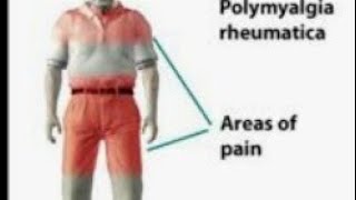 Polymyalgia rheumatica lecture [upl. by Riocard501]