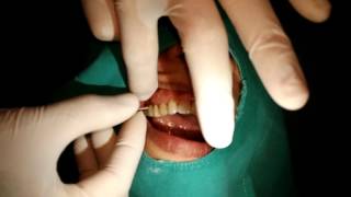 How to use the superfloss between dental bridge [upl. by Susy]