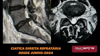 14112024  IL L5S1  SÍNDROME DO RECESSO LATERAL POR HÉRNIA DISCAL  VÍDEO 4K [upl. by Olim]