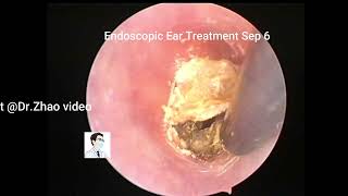 Ear Wax RemovalCerumen embolism and cholesteatoma should be treated [upl. by Ammadis]