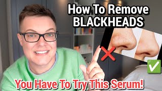 BLACKHEAD REMOVAL  Best Skincare For Blackheads [upl. by Bazluke]