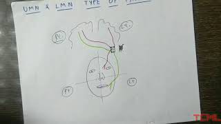 Upper and lower motor neuron type of facial palsy [upl. by Carpenter]