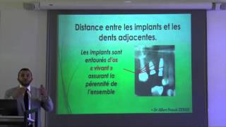 5ème commandement dentaire les règles de positionnement de limplant [upl. by Brose]