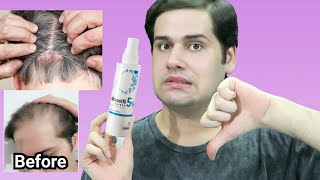 Minoxidil Side Effects  Why I Stopped Using Minoxidil Rosemary Oil VS Rogaine [upl. by Bunni]