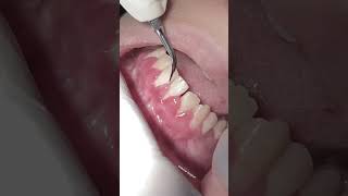 Gingival inflammation gingivitis dentist [upl. by Melania]