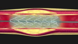 Langioplastie coronaire [upl. by Gnouc]