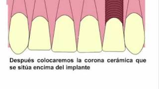 Agenesia dental Ortodoncia y sustitución con implan [upl. by Oemor]