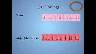 Atrial Fibrillation  AF [upl. by Margareta]