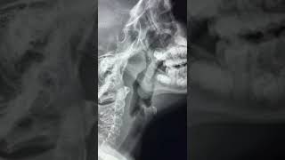 Adenoid and Tonsillar hypertrophy on lateral neck X ray [upl. by Tur]