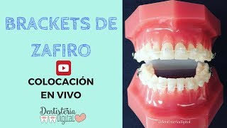 Colocación de brackets de Zafiro EN VIVO [upl. by Latsyrc688]