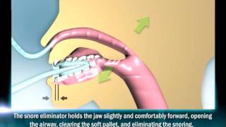 How AntiSnoring Device Works [upl. by Endys]