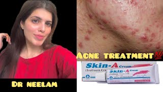 Skin A cream Review  Acne Treatment at Home  How to Use Tretinoin  Tretinoin cream  Dr Neelam [upl. by Ahsam]