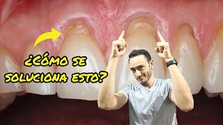 Así se solucionan las encías retraídas recesión gingival [upl. by Ettennahs659]