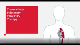 Edwards SAPIEN 3 Transcatheter Pulmonary Valve Replacement Procedure Animation [upl. by Sirej166]