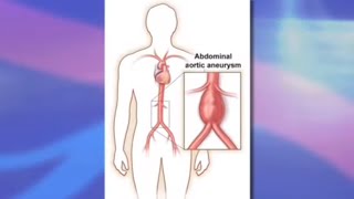 Risks and Benefits of Endovascular Abdominal Aortic Aneurysm Repair EVAR [upl. by Brunelle]