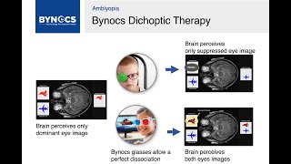 Understanding Bynocs DICHOPTIC Training for Amblyopia Management  Bynocs Feature  HD [upl. by Hanway]