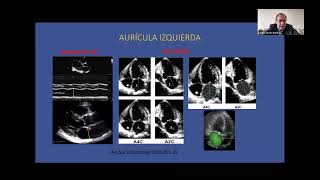 Ecocardiografia en la predicción de embolismo y recurrencia de la FA  Carlos Javier Ramirez [upl. by Notserc]