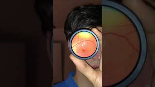 Исследование глазного дня с помощью iPhone Fundus exam with smartphone [upl. by Trebron767]