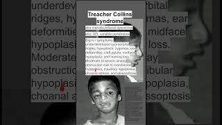 Treacher Collins syndrome [upl. by Nilson381]