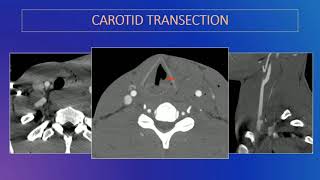 Infrahyoid Neck What the Clinician Wants to Know [upl. by Mikel642]