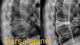 x ray darso lumbar spine Ap and Lateral views  Darso Lumber spine  darsalspine x ray [upl. by Eniger]