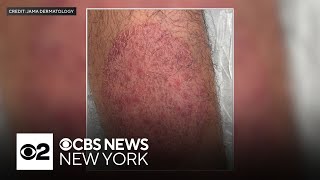 What doctors know about the new sexually transmitted form of ringworm reported in NYC [upl. by Malkah]