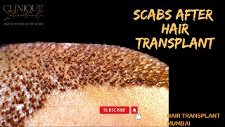 SCABS AFTER HAIR TRANSPLANT  BEST HAIR TRANSPLANT SURGEON  HAIR TRANSPLANT IN INDIA [upl. by Schnell]