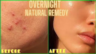 HOW TO GET RID OF ACNE PIMPLES BUMPS ON FACE OVERNIGHT  Simple Home Remedy DIY Lemon Treatment [upl. by Livvyy555]