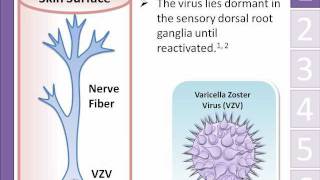 Shingles herpes zoster Animation  Michael Freudiger [upl. by Maye]