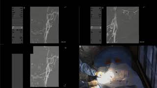 Angioplastia con balón y colocación de stent en estenosis carotídea severa [upl. by Kwapong]