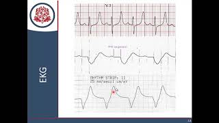 Líquidos y Electrolitos  Parte 4 Hiperkalemia [upl. by Eseret]